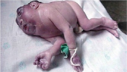 Iniencephaly